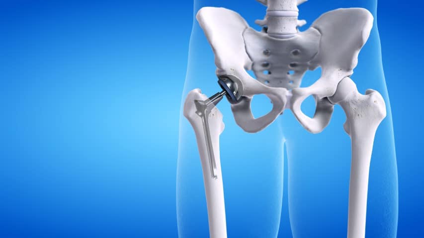 hip replacement surgery rehab pilates